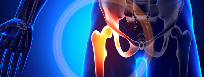 Con le nuove tecnologie la protesi dell'anca è oggi una risposta anche ai pazienti più giovani