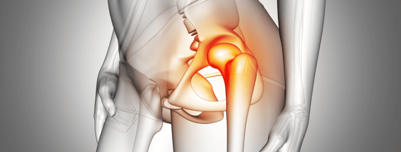 Con la mini protesi si può dare una risposta ai dolori e ai problemi degenerativi dell'anca
